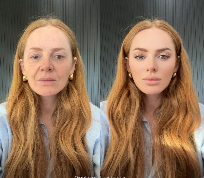 Before and after using 1 syringe of filler for full face and 8 units of neurotoxin in forehead, frown, crow's feet, masseters, and platysmal bands.